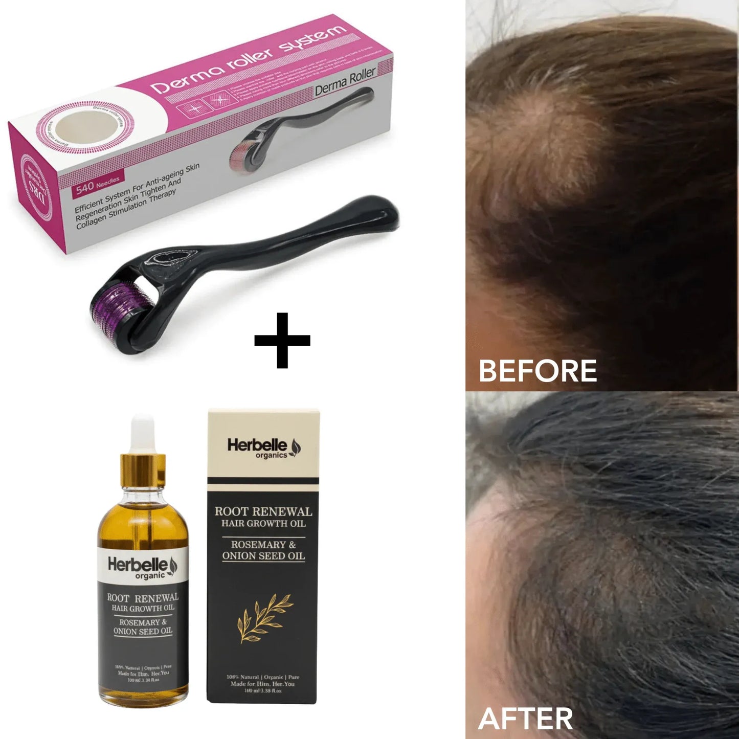 540 Titanium Derma Roller – Microneedling Skin Care Tool for Face, Hair & Beard Growth