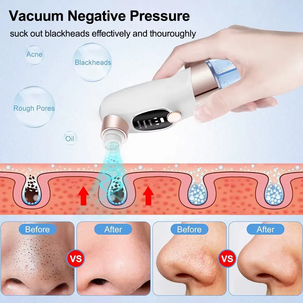 5-in-1 Electric Blackhead Remover Vacuum – Pore Cleaner & Acne Extraction Kit with LCD Display