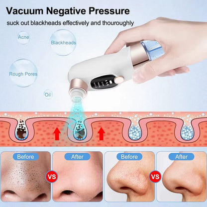 5-in-1 Electric Blackhead Remover Vacuum – Pore Cleaner & Acne Extraction Kit with LCD Display