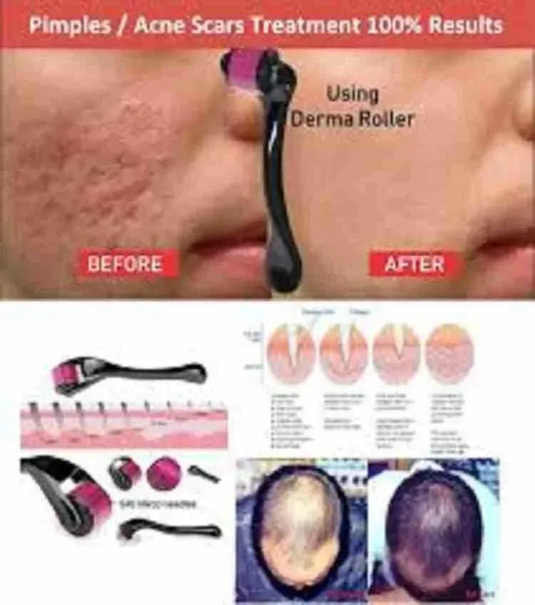 540 Titanium Derma Roller – Microneedling Skin Care Tool for Face, Hair & Beard Growth